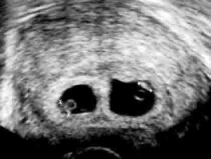 6week ultrasound